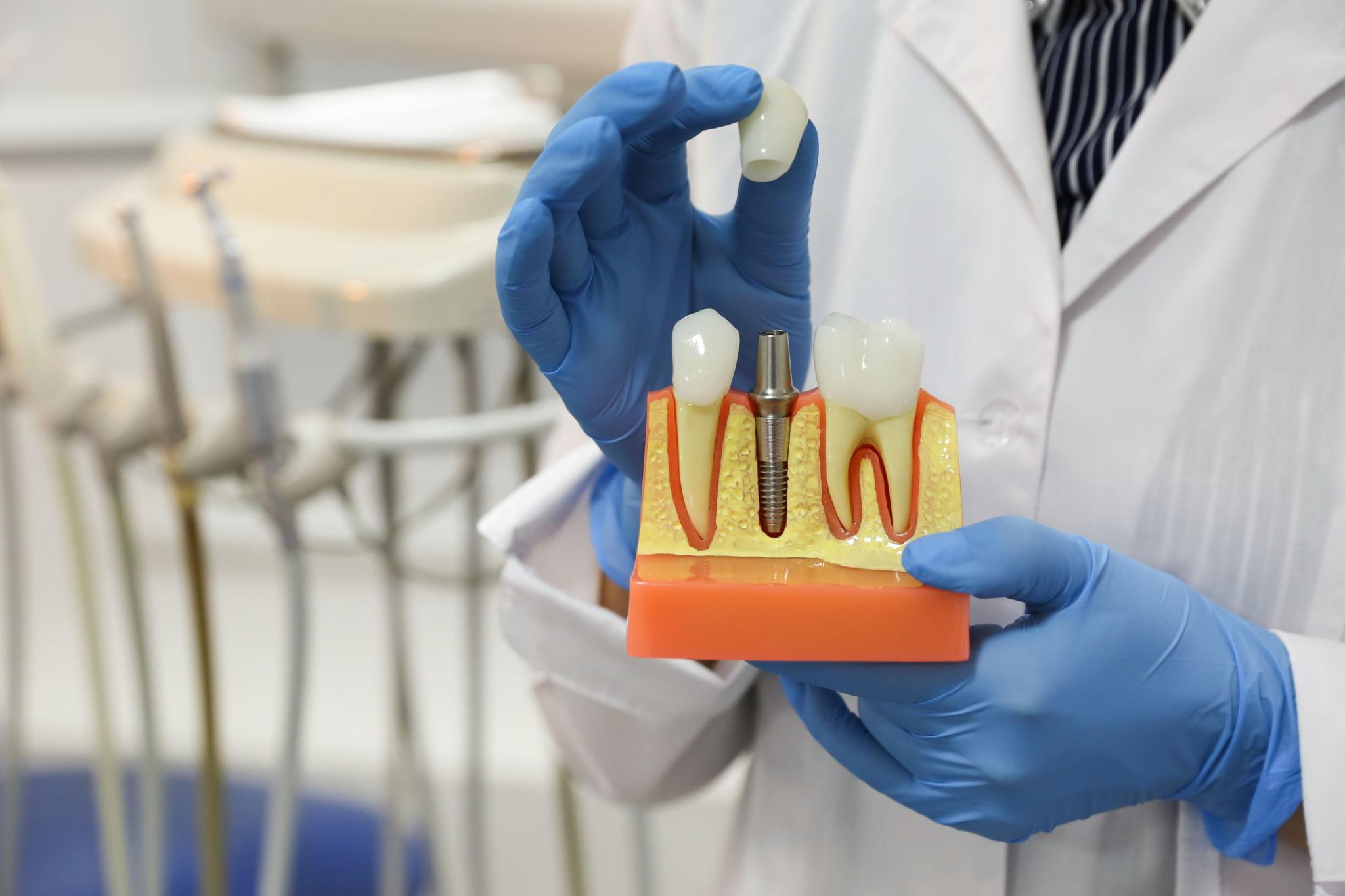 Dental Implants: A Complete Guide