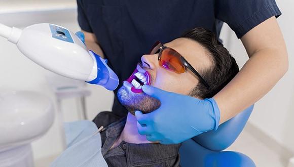 Teeth Whitening: Natural vs. Professional