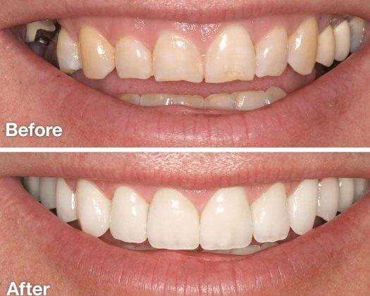 Smile Transformation